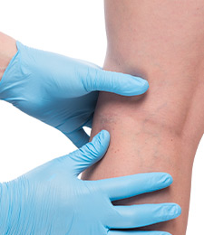 AVLC leg vein removal treatments