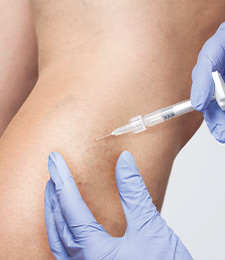 AVLC Sclerotherapy Treatments