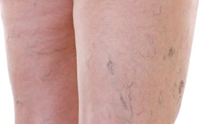The Top Vein Treatment Misconceptions