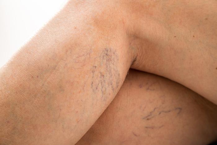 spider veins is a health risk. treat spider veins in york and lancaster with avcl
