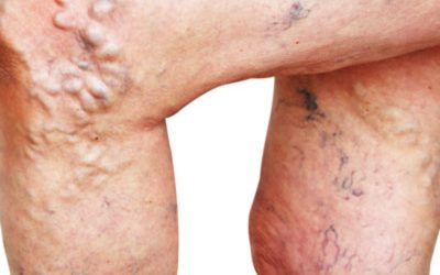 Traditional Sclerotherapy: Treating Vein Conditions