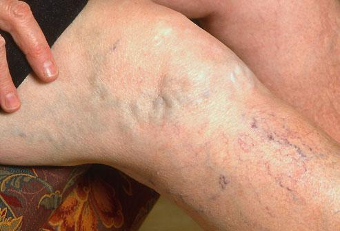 Effect of weight on veins. Get vein treatment in york and lancaster with avcl