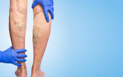 Removing Varicose Veins Has More Than Just Cosmetic Benefits