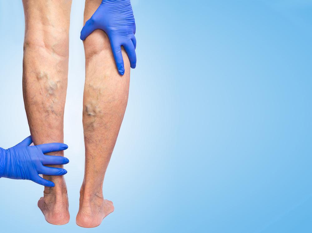 Remove varicose veins in avcl and lancaster with avcl