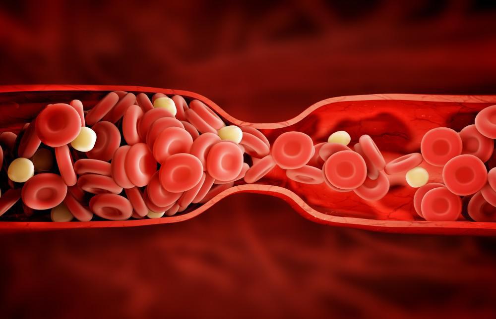 Spotting the Warning Signs of a Blood Clot