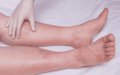 The Importance of Vein Health: Why You   Shouldn’t Ignore Vein Issues