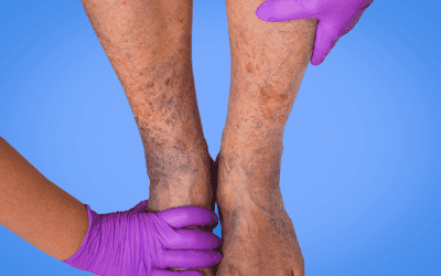 Understanding the Stages of Venous Leg Ulcers