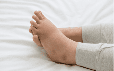5 Warning Signs of Leg Swelling You Shouldn’t Ignore