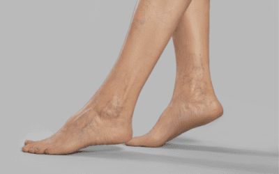 Impact Of Varicose Veins On Ability & Willingness To Exercise