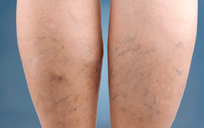 The Impact of Lifestyle Factors on the Progression of Venous Insufficiency