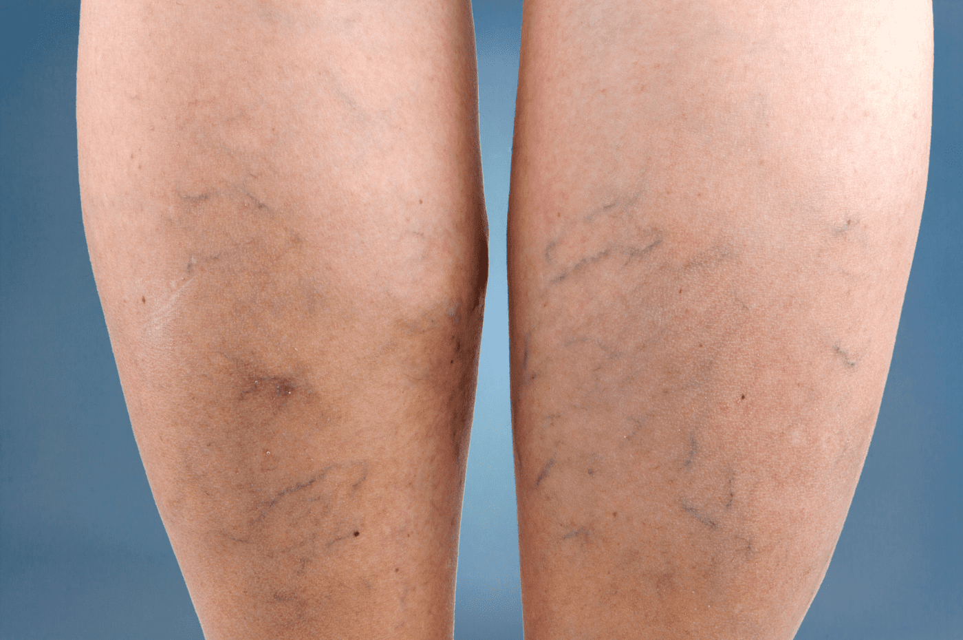 venous insufficiency treatment in york & lancaster