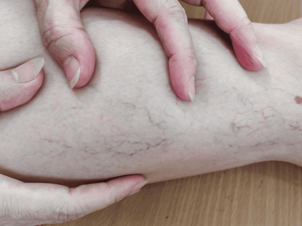 Close-up of a leg with varicose veins, highlighting treatment options at AVLC in York.