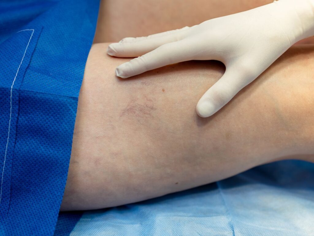 Close‑up of spider veins on legs affecting both men and women, highlighting common vein concerns treated at AVLC in York.