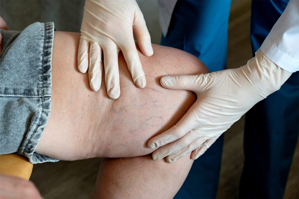 Patient receiving lipedema evaluation and diagnosis at AVLC for chronic leg swelling and discomfort in York.