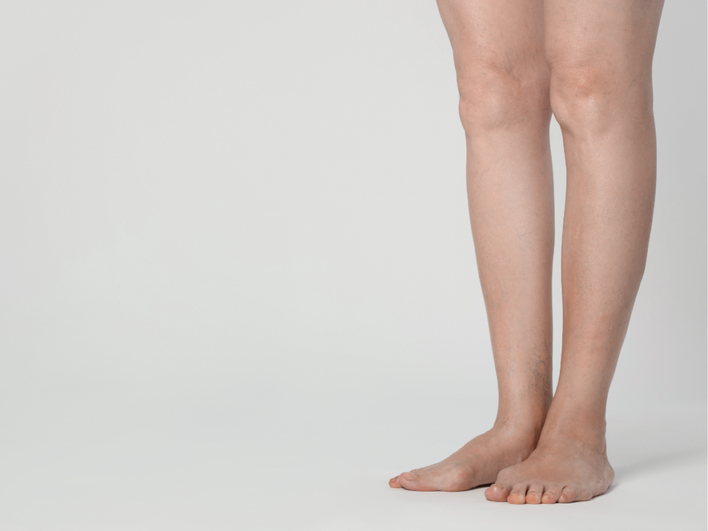 Vein specialist at Advanced Vein and Laser Center in York, PA discussing ambulatory phlebectomy as a treatment option for larger varicose veins
